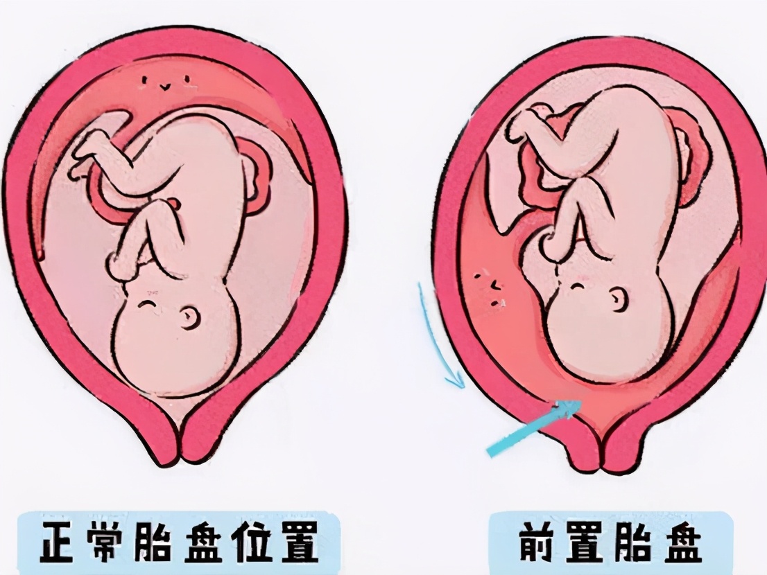 怀孕后是胎盘前壁好还是后壁好，你怎么看？ 11