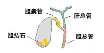 鸡蛋吃多了得胆结石吗（胆结石能吃鸡蛋么） 3